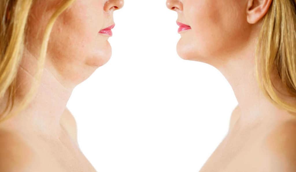 Double Chin treatment Abingdon-on-Thames before and after results
