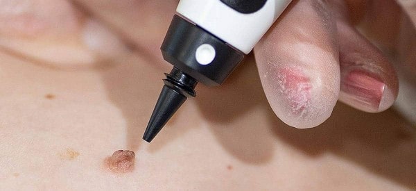 After Skin Tag Removal Abingdon-on-Thames