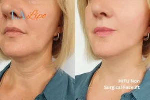 hi-fu for wrinkles Abingdon-on-Thames before and after results