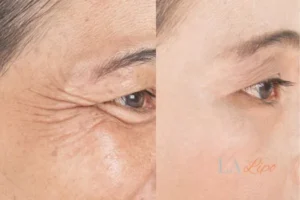 Before and after results of woman - HI-fu wrinkles reduction treatment Abingdon-on-Thames