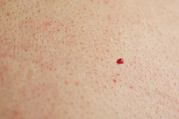 close up of a cherry angioma Abingdon-on-Thames