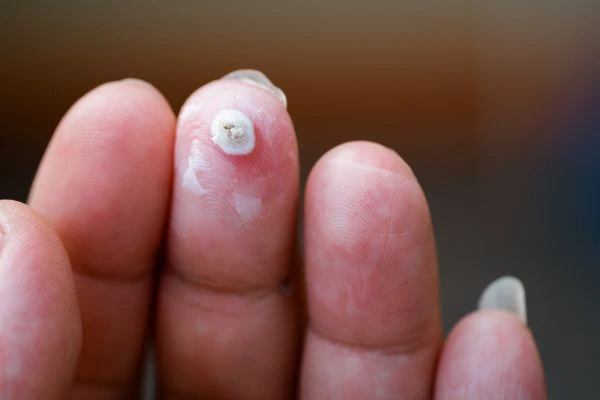wart on person finger - cryotherapy to treat from LA LIPO Abingdon-on-Thames