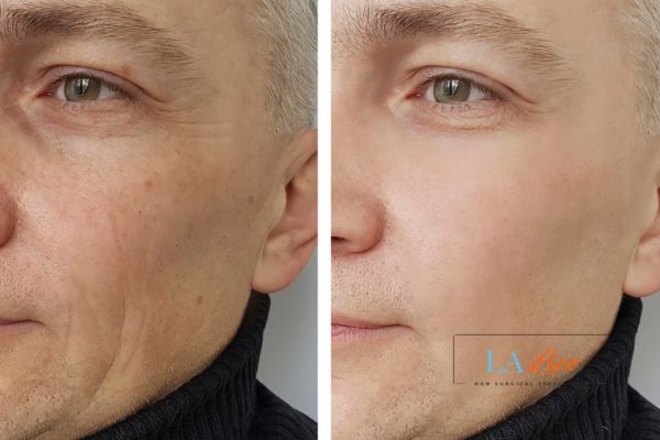 See the amazing results of Morpheus8 Treatment Abingdon-on-Thames!