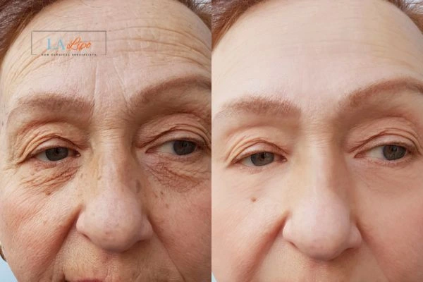 The powerful benefits of Morpheus8 Treatment Abingdon-on-Thames - Call Our team today!