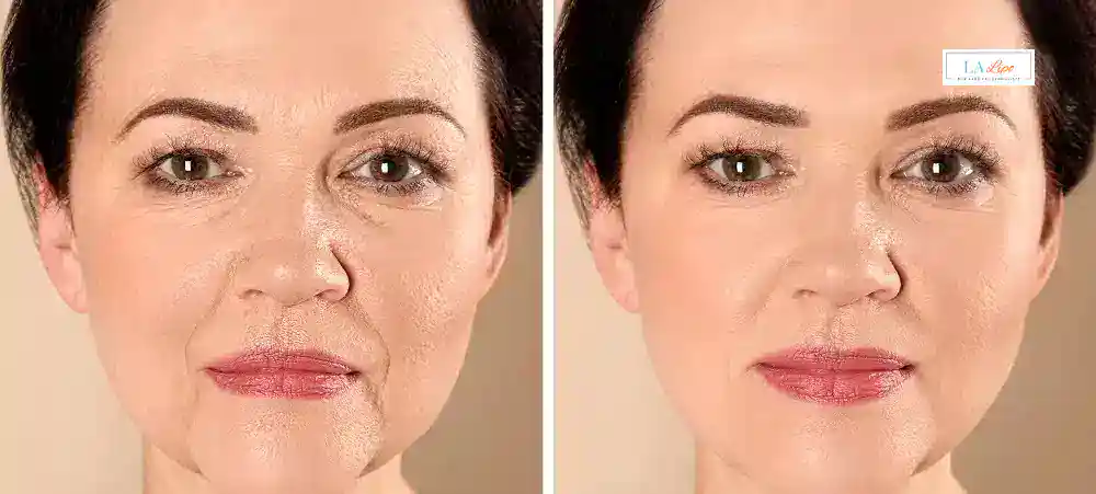 How Long Does It Take to See Results and How Long Do They Last Abingdon-on-Thames?
