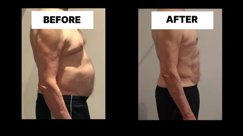 What Symptoms Can Diastasis Recti Cause in Men? Weak Core, Back Pain and Poor Posture Abingdon-on-Thames
